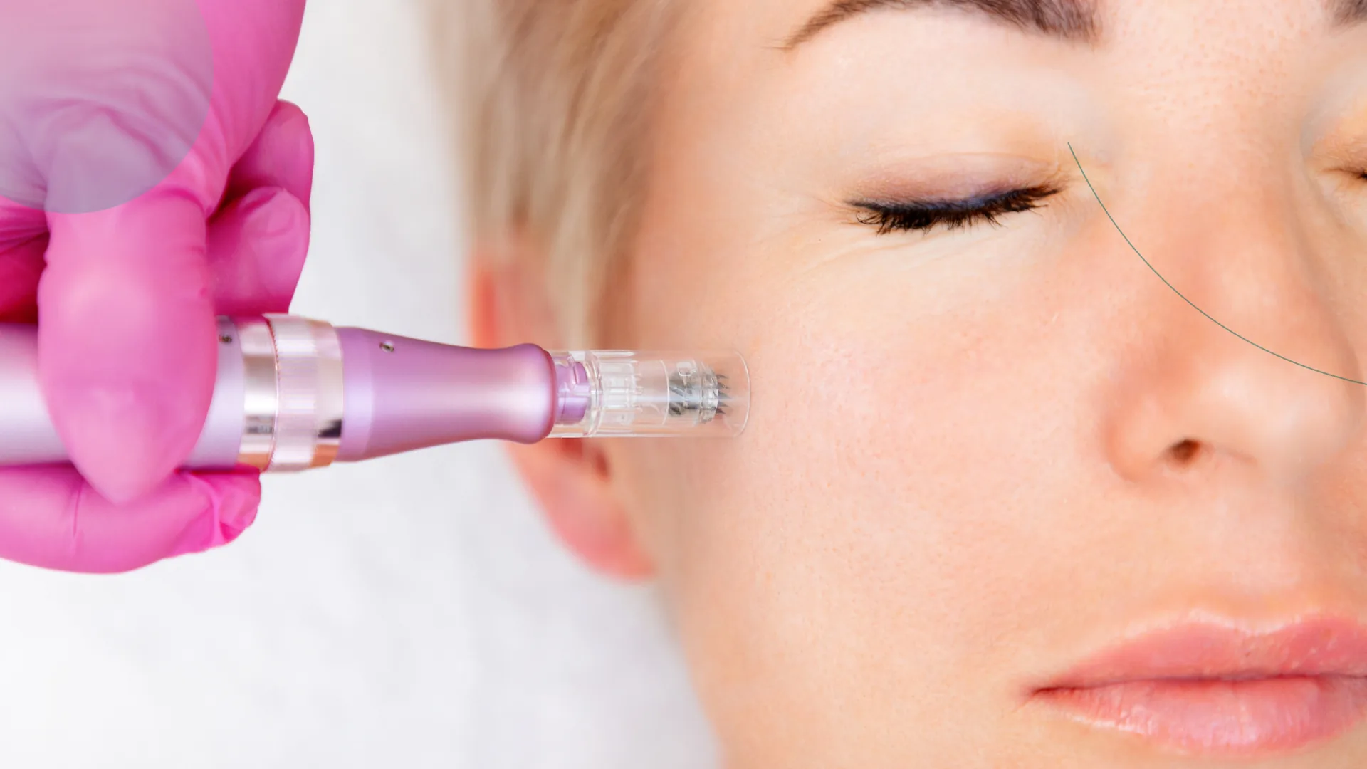 Microneedling facial rejuvenecimiento piel