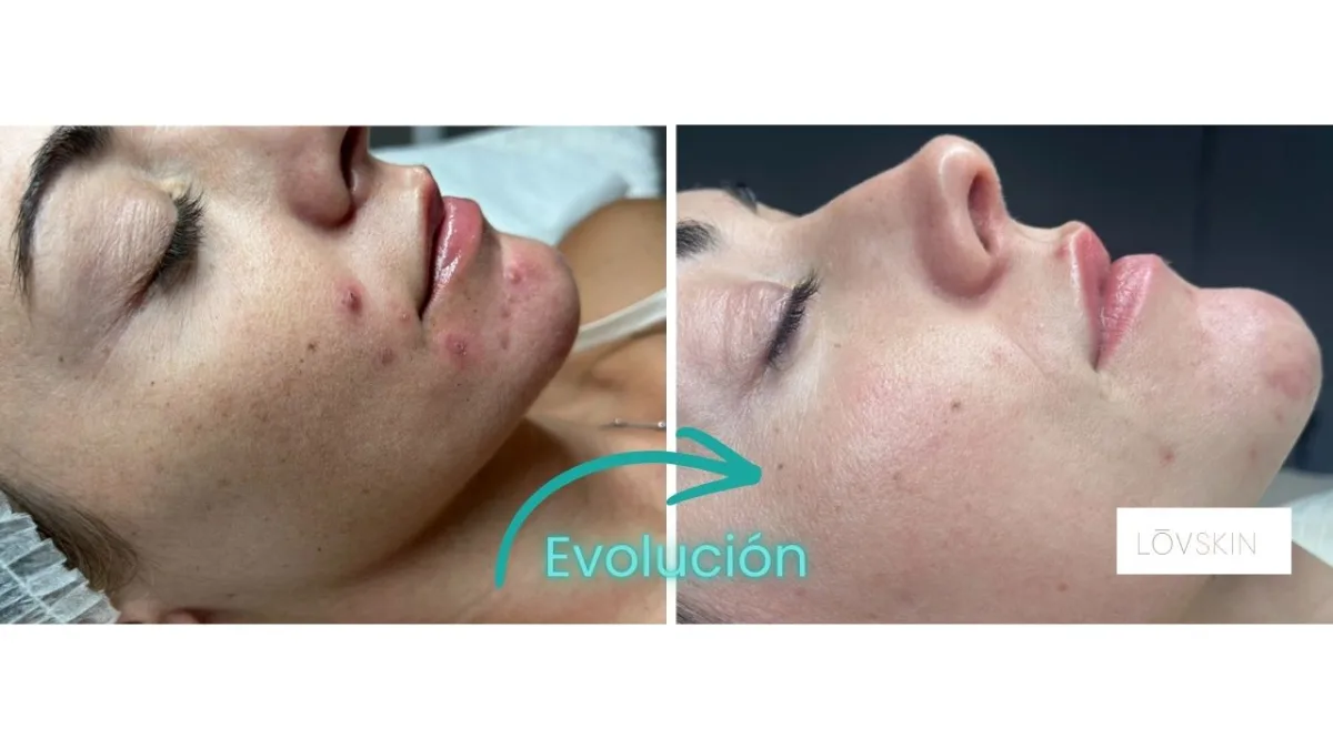 Antes y después de microneedling en Lovskin Estética Facial