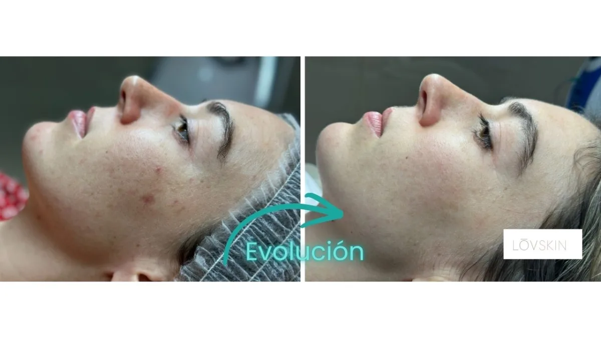 Antes y después de microneedling en Lovskin Estética Facial